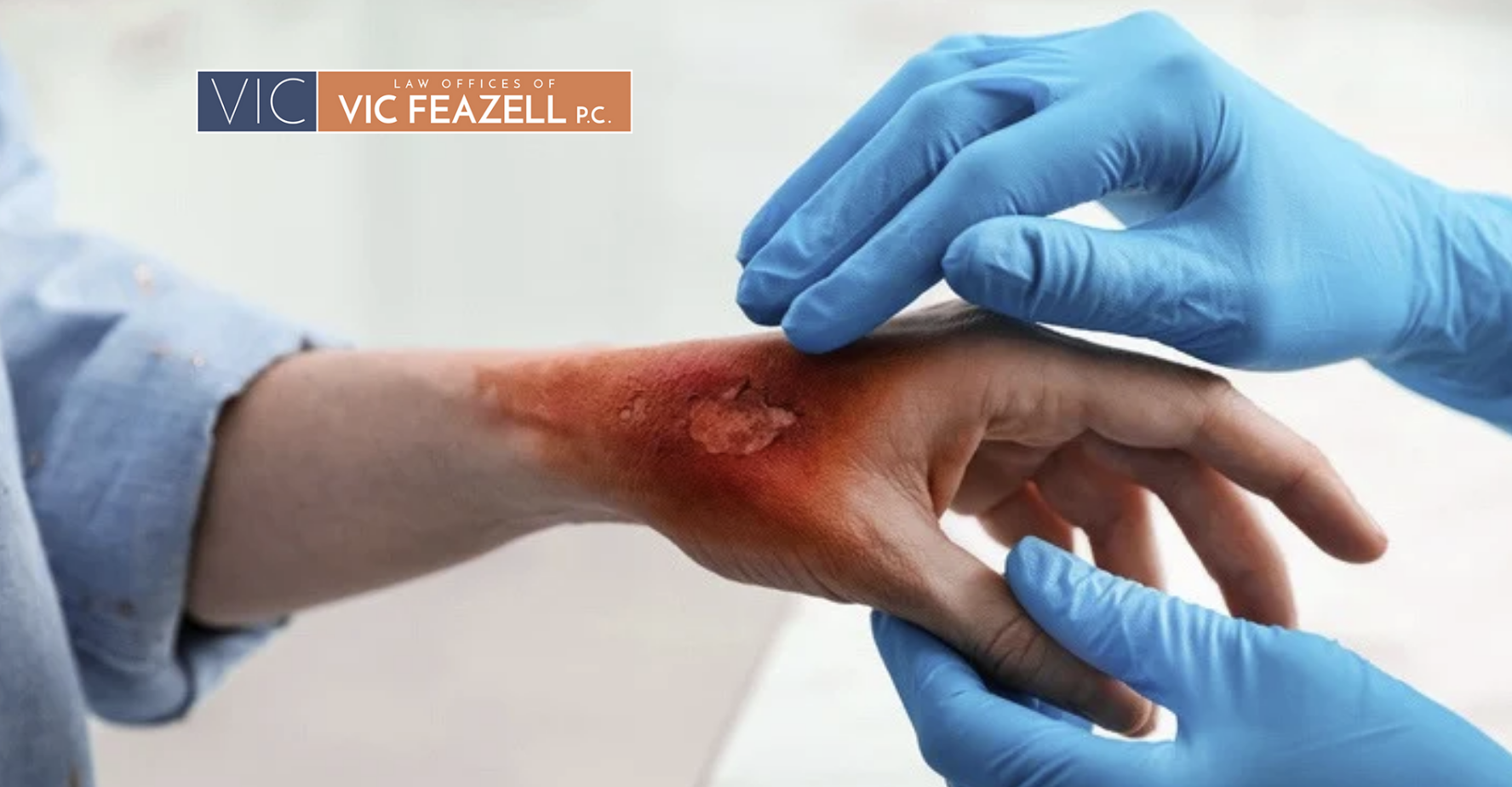 Burn Injuries at Work or Home – Who Can Be Held Liable?