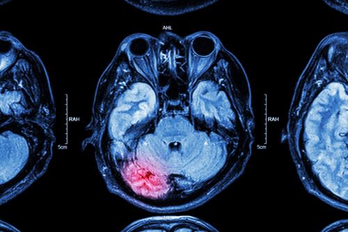 Recovering Compensation with Your Hematoma Claim