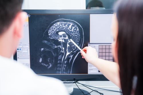Pursuing Claims for Memory Loss Associated With TBIs