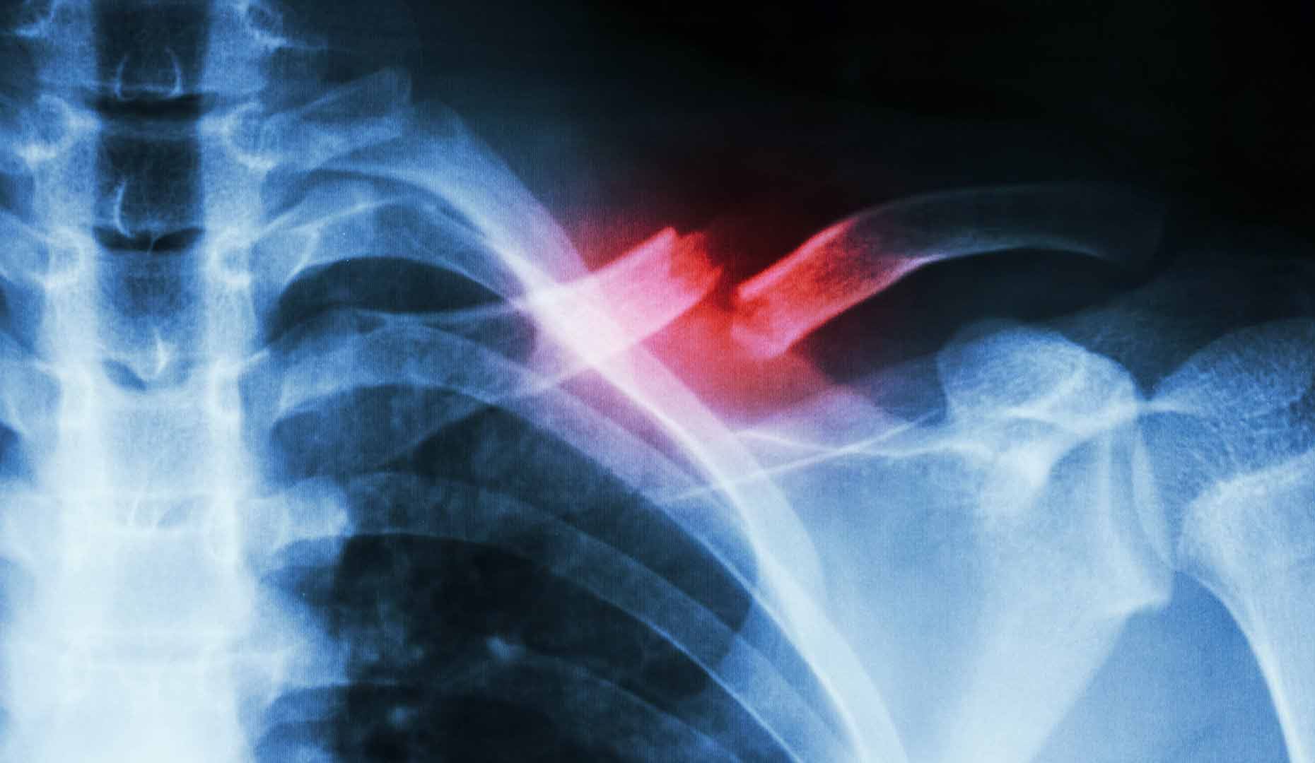 Broken Bone Injury